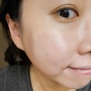 리쥬란힐러 후기, 진짜 아픈데 왜 계속 맞는다는 걸까? (4일차 솔직 후기)