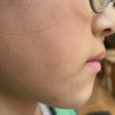 판교 어린이 부정교합 교정, 서울Y치과 7개월 후기 (달라진 아이 미소!)