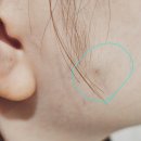 화산삼성의원 | 강남구 송파구 표피낭종,피지낭종 병원,표피낭종실비 (1)