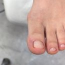 문제성 손, 발 오감네일 이미지