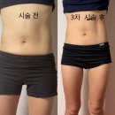 신사행복나눔약국 | [공지] 상상을 현실로 경험하기 위한 복부 리얼 비만탈출기 mpl시술 3차 후기