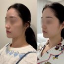 댕글멍 - 북구 서방로 32 | 대구 달서구 온다리프팅 턱보톡스, 이중턱 제거 심부볼 개선 효과 좋아요