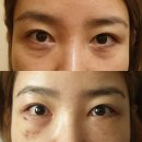 쥬벤스성형외과의원 | [내눈내돈] 눈밑지방재배치 , 귀하의나이가 -5 귀하의생기가 +5되었습니다