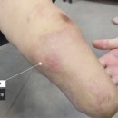 S&P 에스앤피의족케어센터 | <일산의족> 의족교체만으로 드라마틱한 하퇴의족 보행의 변화 : 에스앤피(S&amp;P)의족케어센터 다리의족추천