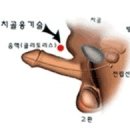 치골융기술 비용 이미지