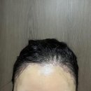 모찌냥 | 모앤라인성형외과│모발이식 후 각진 M자, 어색한 헤어라인과 측면라인 모발이식 재교정