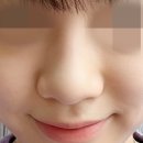 내리길 | 콧볼축소+코끝연골묶기 후기(복코,코끝수술,비공내리기,코지방제거 가격 비용)