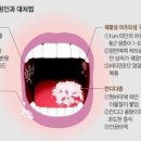 아프타성 구내염 원인 전염될까? 이미지