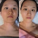 예신관리 TOP 4 정리｜팔뚝 지방흡입 고민하다 선택한 팔뚝 지방추출주사 후기