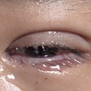 [일상]#중학생 안검내반 수술 한달후기 (용산 연세우리안과의원)