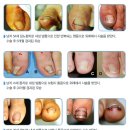 한미정형외과의원 | 내성발톱 자기치료,관리, 수술후기! 내성발톱수술-최경진정형외과