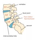 척추분리증(Spondylolysis)의 이해 이미지