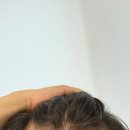 남자 M자 모발이식 후기 ① 수술 당일 기록