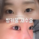 팝성형외과의원 | 팝성형외과 쌍커풀 재수술, 인아웃 쌍커풀 수술 당일 후기