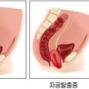 자궁탈출증 및 (밑 빠지는 느낌, 통증) 이미지