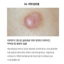 영강의원 | 피부섬유종/쥐젖 실비 보험 가능 여부, 구리 조태훈피부과 방문기[진료시간, 지역화폐 사용 등]