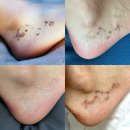 나세르의원 | [강남 문신제거 후기] 나세르 의원 2