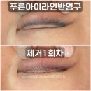 영주미인브로우 | 대구아이라인제거 또는 푸른 아이라인반영구 컬러체인지 1회차 리얼후기