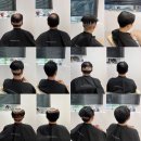 젬마의원 | 모발 이식 후 뒷 머리 삭발 걱정? 노노!