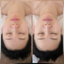 미다올에스테틱 | [서울 이대역] 마이온스킨 | 공덕역피부관리 윤곽관리 후기 | 공덕역 마포역 피부관리