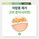 용인항유외과의원 | 동탄지방종 제거 고려 중이시라면 '이것' 먼저 확인하세요!
