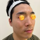 대원메디컬 | 수원 메디컬오 여드름 트러블 모공 리액터 시술 솔직후기 [내돈내산]