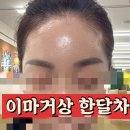 어서멍 | [강남역] 이마거상 한달 후기 이마 거상술 효과 붓기 멍 부작용