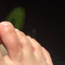 상상메디케어 | 벌레 물려서 호주 응급실 간 후기, 봉와직염, 거의100만원 나왔다