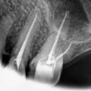 엔도코어 이미지