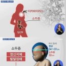 소두증은 바이러스가 아닌 살충제 때문이었다 이미지