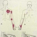 상후거근(serratus posterior superior) 이미지