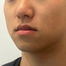 블루멍 | 강남 신논현역 피부과 남자 튠페이스 블루 튠레이저 부작용 멍 통증 후기