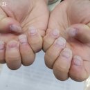 킴스바디아트 | "손톱 콤플렉스, 이젠 안녕! 물어뜯는 손톱 교정으로 얻은 놀라운 변화"