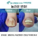 장평육교(신현중 쪽) | 김해발톱관리 누구나 가능해요