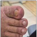 레푸스 잠실역점 내성발톱·무좀발톱·발각질·문제성발