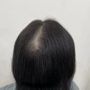 정수리 이미지