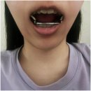 다움치과의원 | 웃을때 마녀턱 턱깍는 수술 없이 탈출하는 법