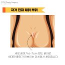 토브성형외과의원 네이버블로그