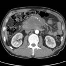 췌장암에 대하여 전반적인 개요 이미지