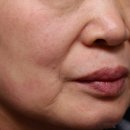 부평초등학교 | 부평피부과 레디어스 스킨부스터 후기｜팔자·입가 주름 처짐 변화 (전후비교)