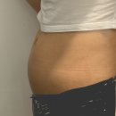 조한의원 | 부산 서면 슬림핏 한의원 살톡스 한 달 차 후기 (+ 플러스톡)