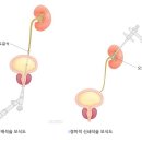 여름철 불청객, 요로결석 이미지