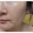 역삼밴스의원 | 역삼밴스의원 피부과 리팟레이저 흑자제거 했어요