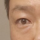 오빗의원 | 눈밑지방재배치 레이저 시술 오빗클리닉(압구정) 후기(진행형) 최종 5개월째 상태 업데이트.