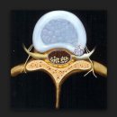 disc herniation에 대한 Nabil 동영상 - foraminal disc가 무려 8~10% 이미지