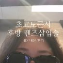 선릉안경 | 초고도난시 렌즈삽입술 1일차 내돈내산 후기 (ㅋㅇ안과 / 선릉역안과)