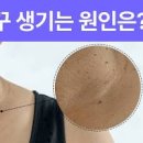 연성섬유종 쥐젖 원인 증상 목 사타구니 쥐젖 제거 치료 방법 이미지