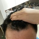 원주탈모병원 추천 청담심스 통해 자신감을