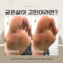 케어로 | 굳은살, 각질 고민 끝! 프리앤드 발 케어로 달라진 후기
