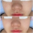뚜레쥬르 광주수완대방 | 광주 수완지구 피부관리 세이뷰티 모공클리닉 관리 후기